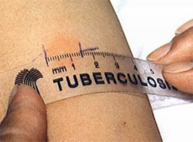 http://tuberkulez-forever.com/wp-content/uploads/2011/11/likbez/foto15.jpg