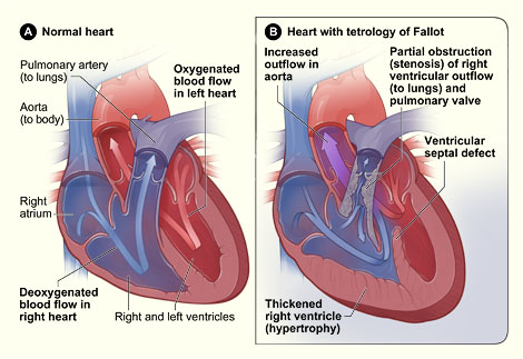 Picture of Tetrology Fallot Heart Defect