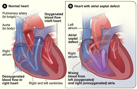 Picture of Atrial Septal Defect