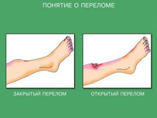 http://*****/data/images/p6_p59_perelom.jpg
