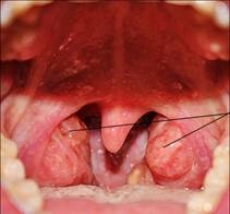 воспаление гланд