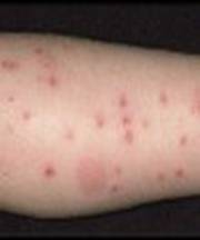 bug_bites_flea