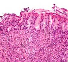 http://upload.wikimedia.org/wikipedia/commons/thumb/5/58/Gastritis_helicobacter_-_intermed_mag.jpg/250px-Gastritis_helicobacter_-_intermed_mag.jpg