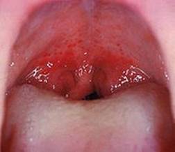 190px-Streptococcal_pharyngitis.jpg