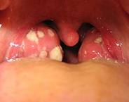 250px-Tonsillitis.jpg