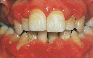 http://www.meetadentist.com/dentalcare/wp-content/uploads/2012/08/Gingivitis.jpg