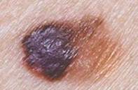 http://mosderm.ru/uploads/Statiy/2313123.jpg