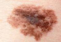 http://mosderm.ru/uploads/Statiy/.jpg