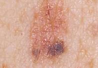 http://mosderm.ru/uploads/Statiy/.jpg