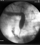 http://gastroendoscopy.ru/NAtlas/disease/figures/str3.gif