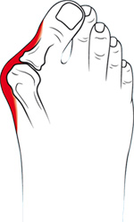 hallux valgus