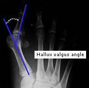 http://www.vrach-travmatolog.ru/img/content/hallux-valgus-angle-1.jpg