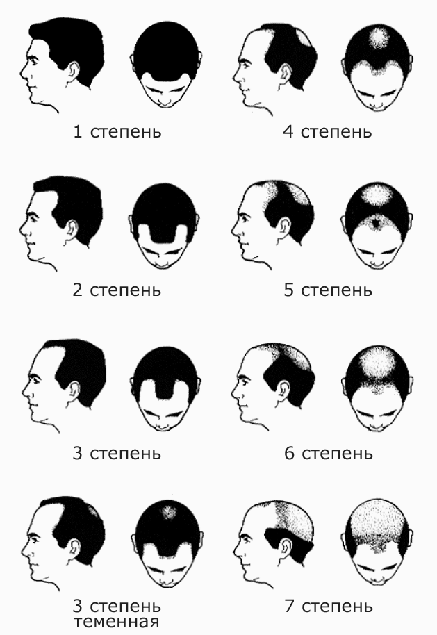 Описание: Степени облысения по Норвуду
