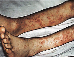 http://diseases.academic.ru/pictures/diseases/370_370_1.jpg