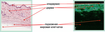 ультразвуковой скан кожи