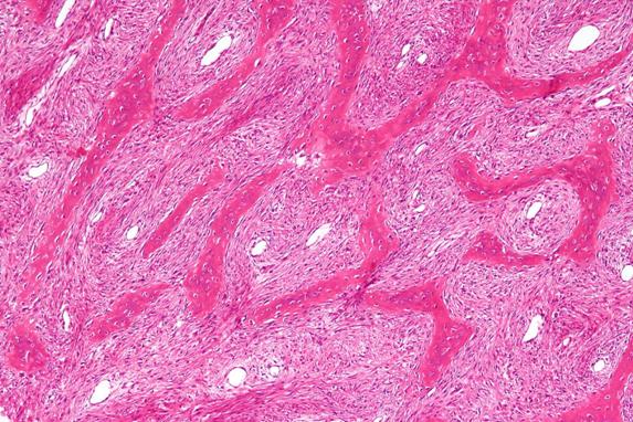 Fibrous dysplasia - intermed mag.jpg