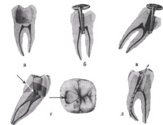 http://clubdent.narod.ru/profess/knigohr/clinendo/images/image114.jpg
