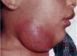 http://znaniyapolza.ru/wp-content/uploads/2014/02/odontogennyj-podcheljustnoj-limfadenit-oslozhnivshijsja-abscessom.jpg