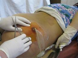 http://nebolet.com/medimg/content/postinekcionnyj-abscess-6.jpg