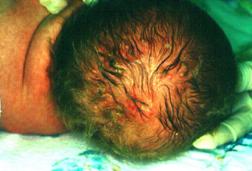 Herpes Neonatorum