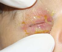 Herpes Neonatorum