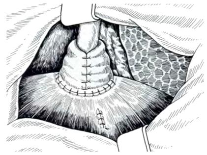 http://www.allsurgery.ru/images/fundoplikaciya.jpg