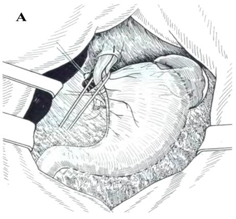 http://www.allsurgery.ru/images/sposob_nissen_1.jpg