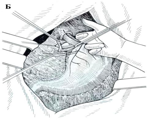 http://www.allsurgery.ru/images/sposob_nissen_2.jpg