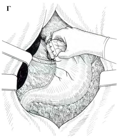 http://www.allsurgery.ru/images/sposob_nissen_4.jpg