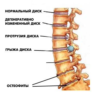 ��������: http://www.orthospine.ru/library/patient/img/borchenko_03.jpg