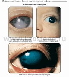 C:\Documents and Settings\home\Рабочий стол\Учёба\суп\Педиатрия с детскими инфекциями\Pediatr_Infec155_0119.png