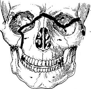http://vmede.org/sait/content/Travmatologiya_4lx_afan_2010/6_files/mb4_004.jpeg