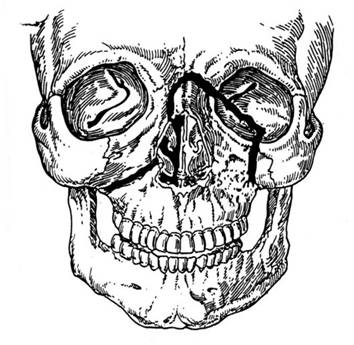 http://vmede.org/sait/content/Travmatologiya_4lx_afan_2010/6_files/mb4_002.jpeg