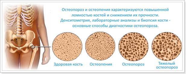 https://vash-ortoped.ru/wp-content/uploads/2017/09/s-vozrastom-osteoporoz-mozhet-progressirovat.jpg