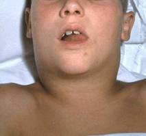 Diphtheria