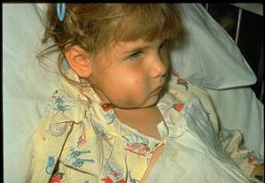 Hib Infection