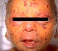 rubella