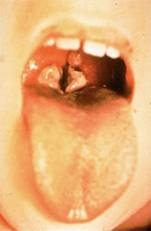 diphtheria"