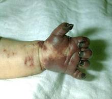 Gangrene