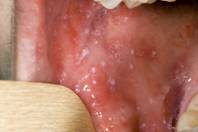 ca0811measles4_190346