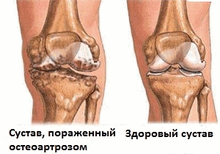 osteoartroz