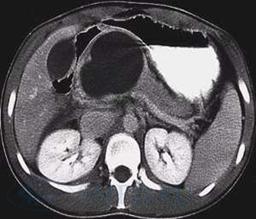 http://old.smed.ru/userfiles/image/preview_pancreatitis%20acute%20CT%20pseudocyst.JPG