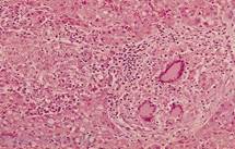http://hcv.ru/articles/bliver/image/port_hyper_biopsy_tbs.jpg