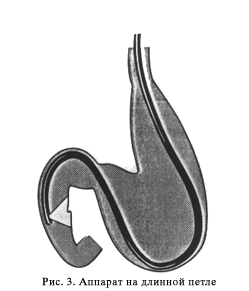 http://gastroendoscopy.ru/artpic/a31c.gif