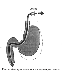 http://gastroendoscopy.ru/artpic/a31d.gif